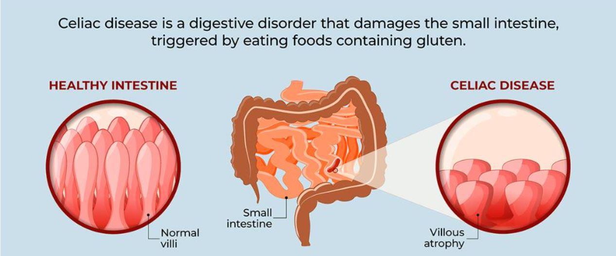 Celiac Disease and Gut Health