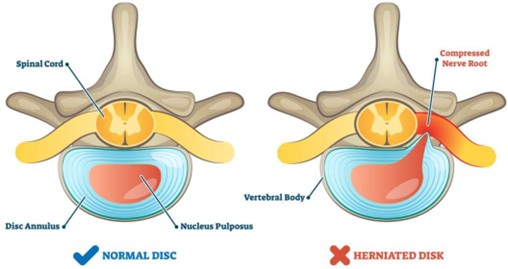 Normal vs Herniated Disc