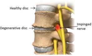 Degenerative Disc