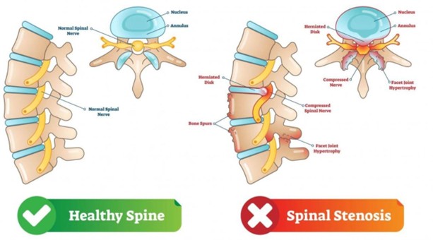 Healthy Spine vs Spinal Stenosis